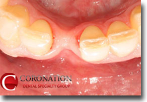 Narrow jaw bone that requires a bone graft before a dental implant can be placed.